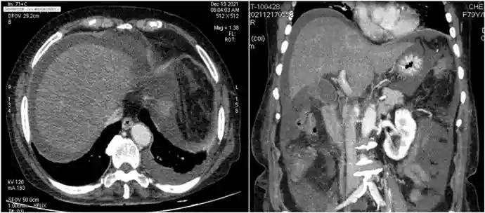 服用自种“三七”来养生？小心肝窦阻塞综合征